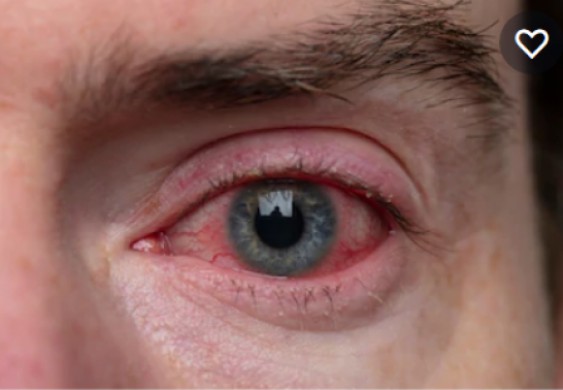 "كوفيد تو"..مؤشرات غير تقليدية للإصابة بكورونا - الحرة