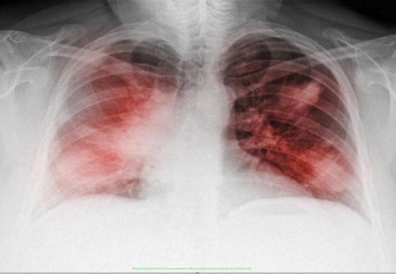 4 علامات لـ "نقص الأكسجة الصامت" الذي قد يكون مميتا لمرضى "كوفيد 19" - RT Arabic