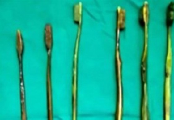 7 فراشي أسنان ابتلعتها فتاة بعد محاولة إجبارها على الزواج