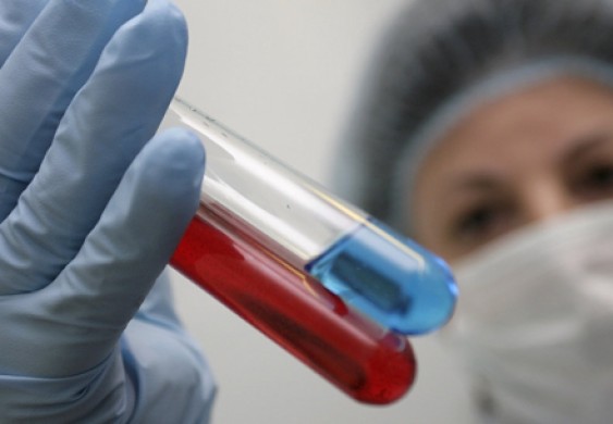 أطباء بريطانيون: علاج محتمل لنقص المناعة البشري