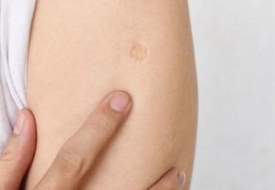 التطعيم ضد الدرن قد يقلل الإصابات بعدوى {كورونا}