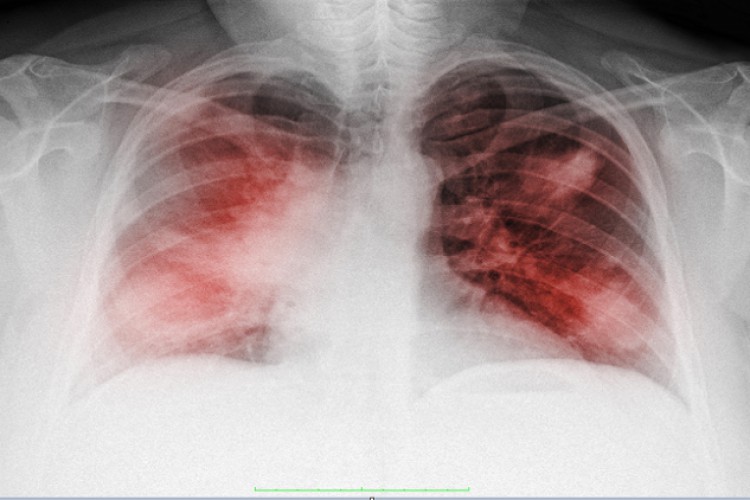 4 علامات لـ "نقص الأكسجة الصامت" الذي قد يكون مميتا لمرضى "كوفيد 19" - RT Arabic