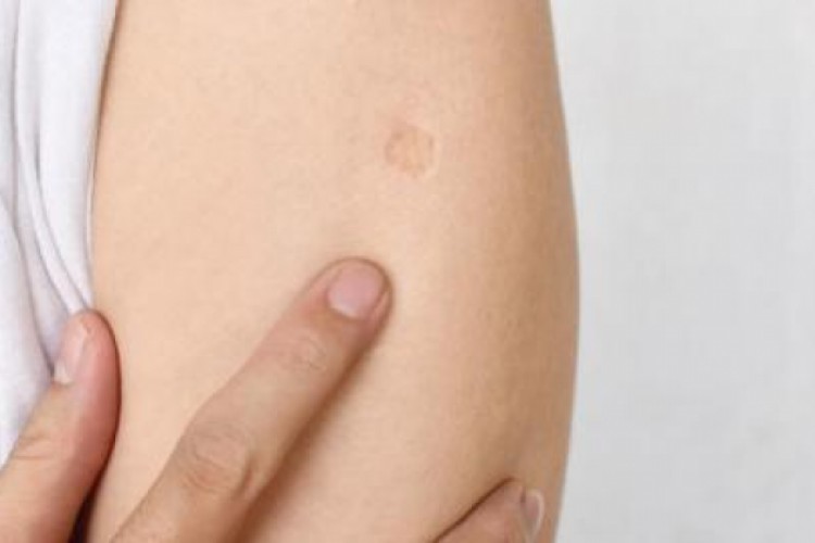 التطعيم ضد الدرن قد يقلل الإصابات بعدوى {كورونا}